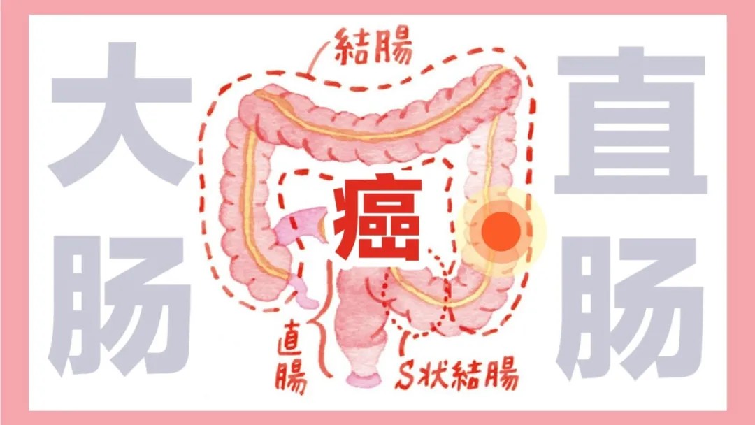 结肠癌.jpg