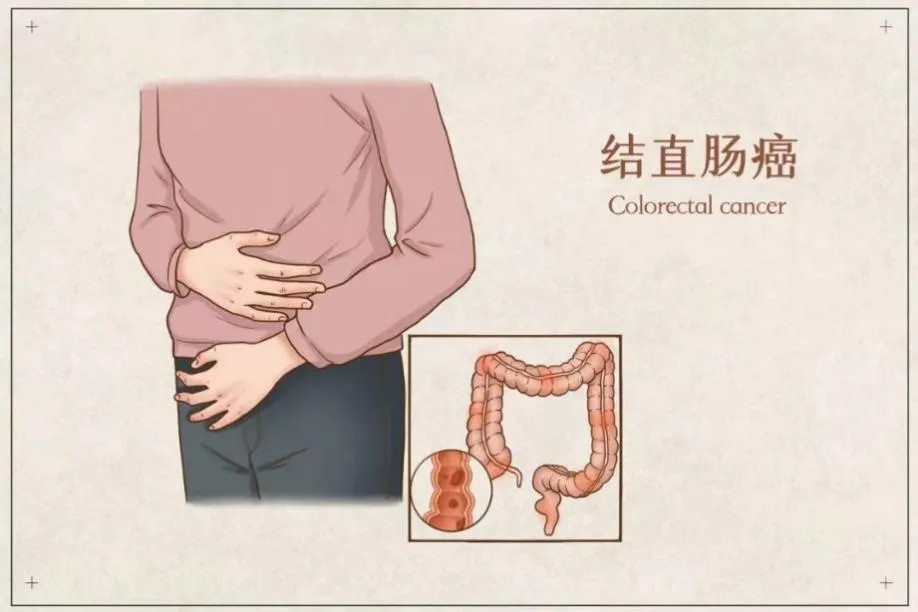 结直肠癌.jpg